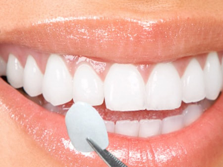 Có thể tẩy trắng răng sau khi trám không ?
